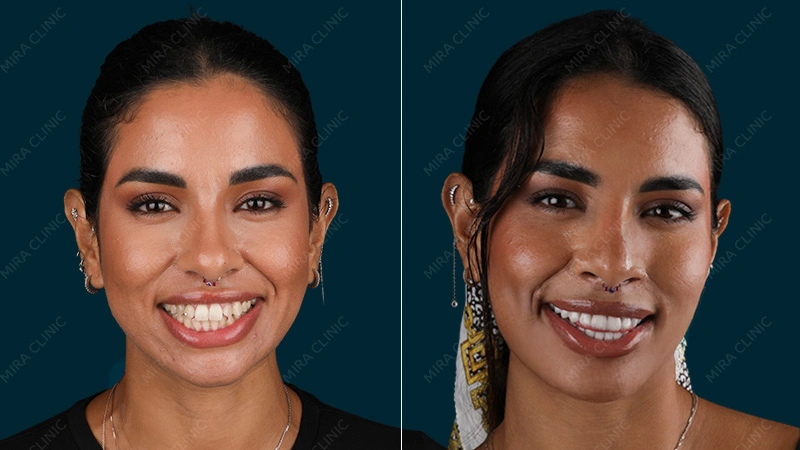 ابتسامة هوليوود إيمان قبل وبعد